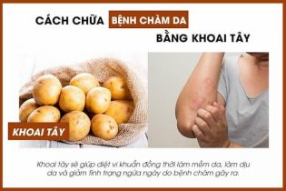 Cách chữa bệnh chàm bằng khoai tây hiệu quả