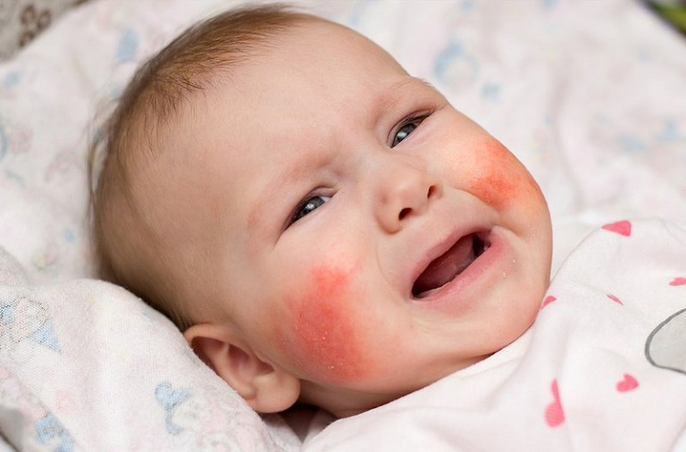 Với sức đề kháng, hệ miễn dịch yếu, trẻ em là một trong những đối tượng rất dễ bị viêm da dị ứng