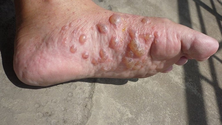 Bệnh tổ đỉa ở lòng bàn chân là bệnh rất nhiều người gặp phải