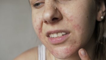 Da mặt bị ngứa và nổi mụn - nguyên nhân cùng cách điều trị