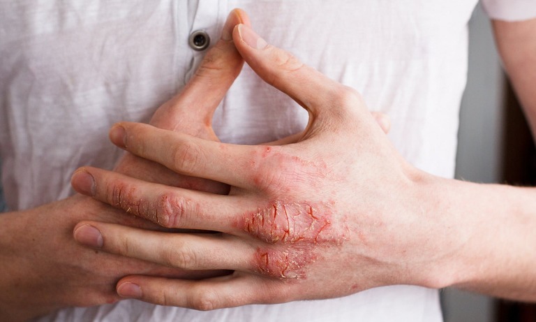 Viêm da tiếp xúc cũng là nguyên nhân gây bệnh