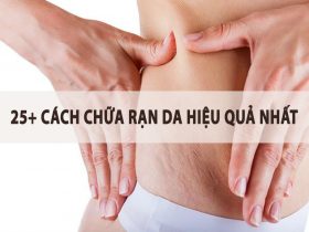 Cách chữa rạn da hiệu quả