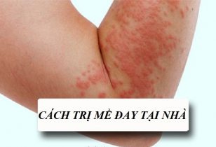 Cách trị nổi mề đay tại nhà: