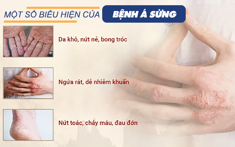 Bệnh á sừng có nhiều biểu hiện khiến người mắc bệnh cảm thấy khó chịu, ảnh hưởng đến sinh hoạt và cuộc sống