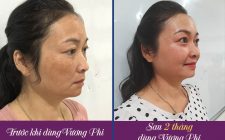 Kết quả sau 2 tháng điều trị nám với Bộ sản phẩm Vương Phi của tôi