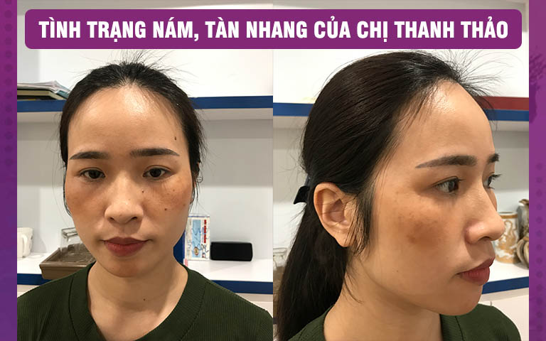 Chị Thảo từng thực hiện điều trị nám, tàn nhang bằng laser nhưng không nhận được hiệu quả như mong đợi