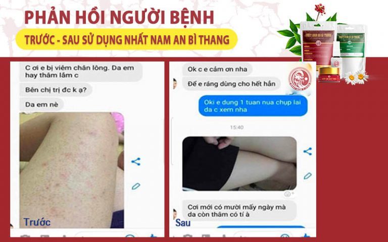 Phản hồi của Tiên về hiệu quả điều trị viêm nang lông với Nhất Nam An Bì Thang do bộ phận chăm sóc khách hàng Trung tâm Da liễu Đông y Việt Nam cung cấp