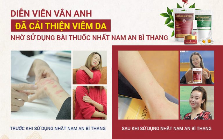 Hình ảnh trước và sau khi sử dụng bài thuốc An Bì Thang