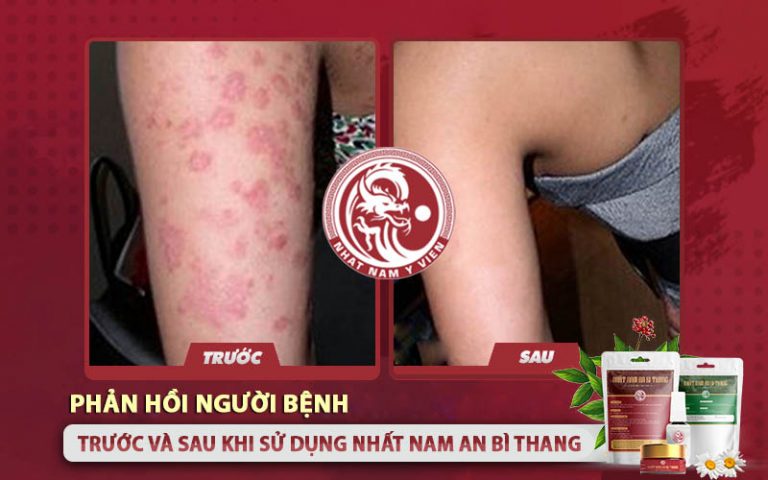 Người bệnh sau khi cải thiện được làn da vảy nến nhờ Nhất Nam An Bì Thang