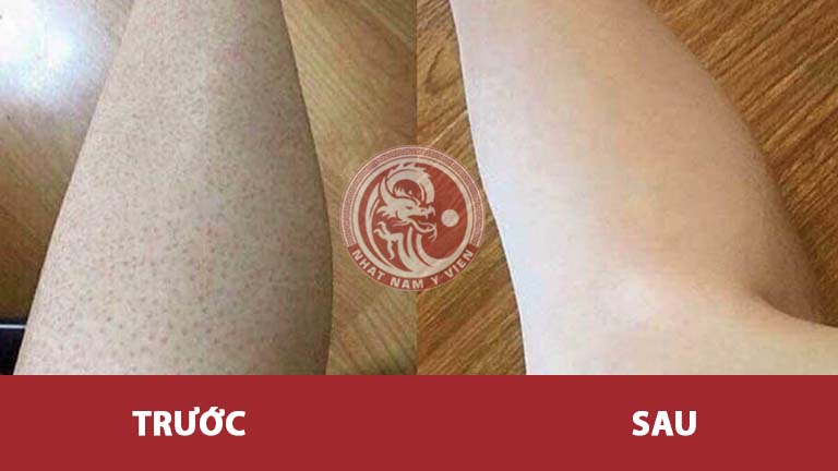 Hình ảnh trước và sau điều trị viêm nang lông của Hoàng Ngọc Quyên với bài thuốc Nhất Nam An Bì Thang