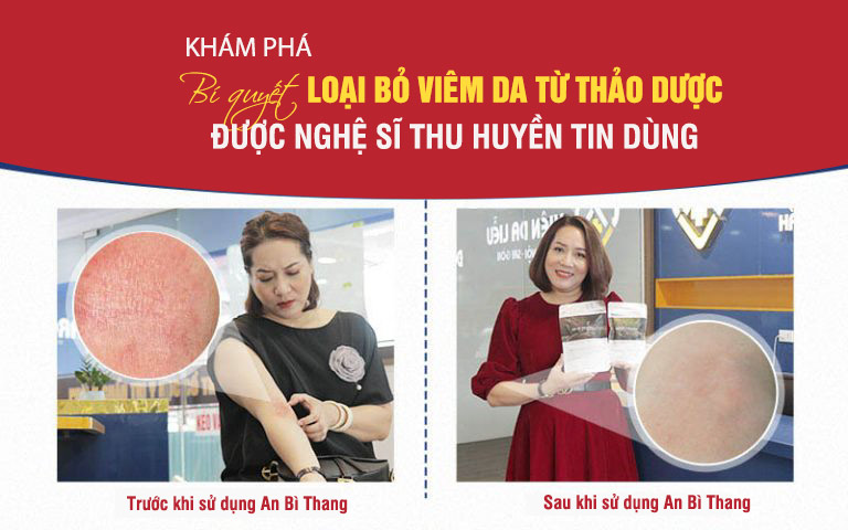 Làn da của nghệ sĩ Thu Huyền đã được cải thiện rõ rệt chỉ sau 2 tháng tới Trung tâm Da liễu Đông y Việt Nam điều trị viêm da cơ địa