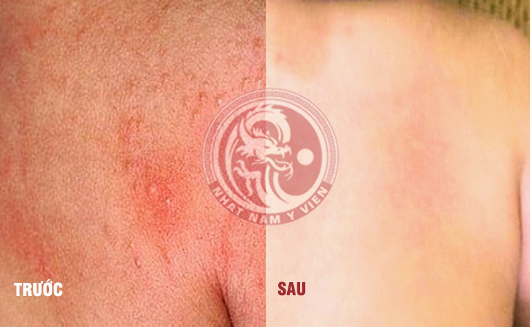 Da lưng bé trước và sau khi điều trị viêm da bằng Nhất Nam An Bì Thang