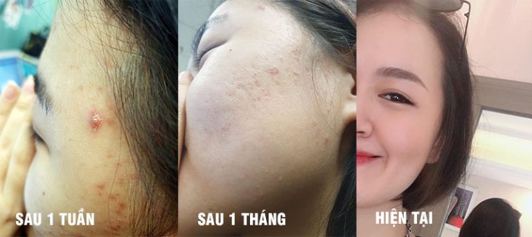 Khách hàng Hoàng Chi đã thành công trị mụn với Nhất Nam Hoàn Nguyên Bì