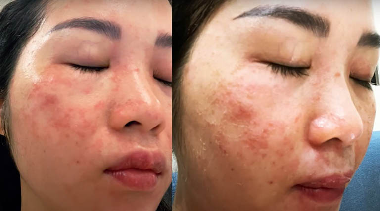 Da tổn thương do corticoid, laser có thể sử dụng Vương Phi để phục hồi da