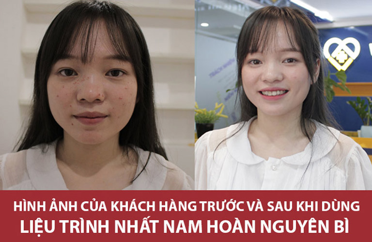 Làn da của Linh đã cải thiện rất tốt sau khi sử dụng liệu trình trị mụn Nhất Nam Hoàn Nguyên Bì