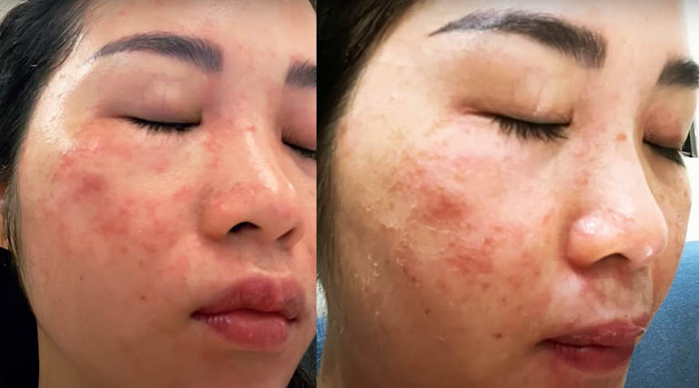 Làn da bị tổn thương do laser sai cách của chị Huyền Trang