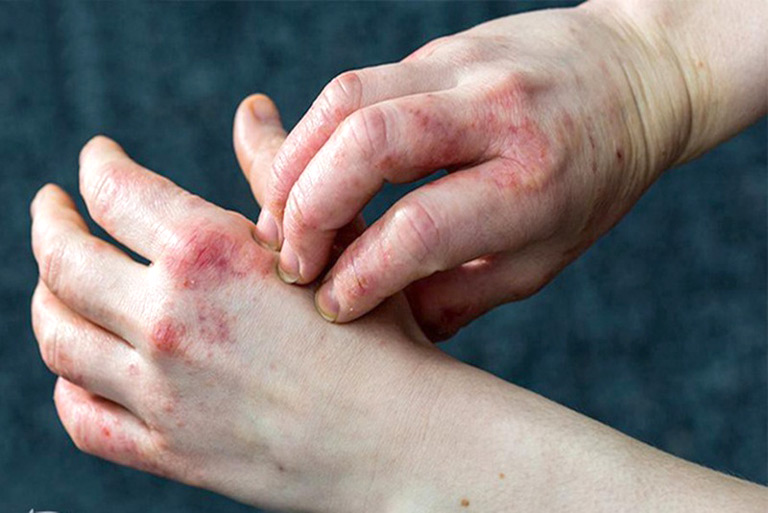 Eczema là bệnh lý da liễu phổ biến có thể gặp ở mọi lứa tuổi