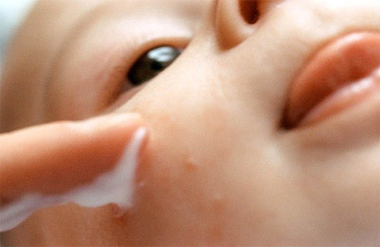 Kem bôi chàm sữa được dùng phổ biến cho trẻ nhỏ 