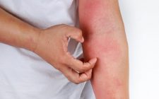 Gây ngứa ngáy khó chịu, ảnh hưởng giấc ngủ, suy nhược cơ thể và hệ miễn dịch kém hơn
