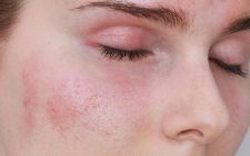 Ảnh hưởng đến tâm lý, gây lo lắng, stress, thậm chí trầm cảm ở một số bệnh nhân