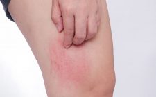 Ảnh hưởng đến sinh hoạt hàng ngày, người bệnh luôn bị khó chịu, mệt mỏi, bứt dứt