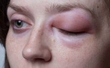 Biến chứng nguy hiểm như phù mạch, sốc phản vệ nếu không được kiểm soát tốt